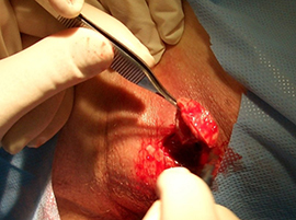 Chirurgisches Debridement mit Skalpell und Pinzette