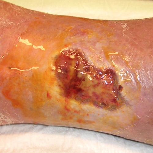 Abb2-rueckstaende-durch-hydrokolloidverband.jpg