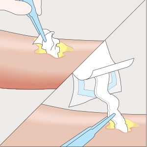 Mesalt – Anwendungsschritt 2